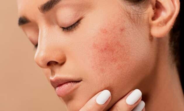 Manfaat Serum Untuk Wajah Berjerawat